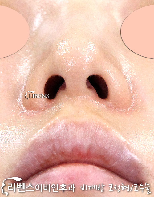 매부리코 메부리코 코끝 성형 수술 무보형물 코뼈 내측 외측 절골 성형 s640